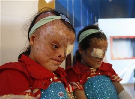 伊拉克儿童身上的战争之伤